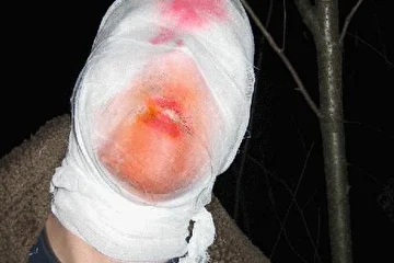 Остатки былого удовольвствия от обжирания собственной кожи на собственном лице.
